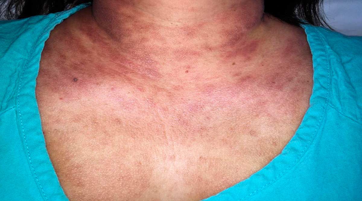 Puede ocasionar el estrés enfermedades en piel: IMSS