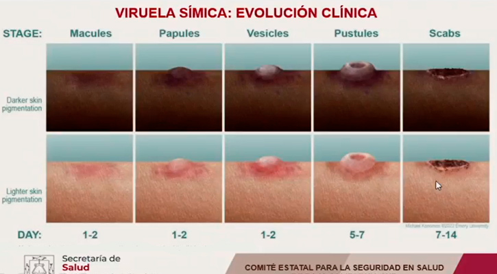 En estudio 6 casos de viruela del mono en BCS; solo hay uno confirmado, asegura SSA