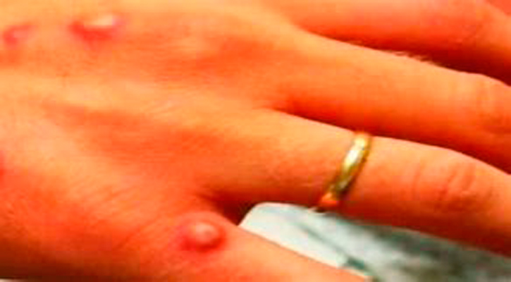 Resultaron negativas por viruela del mono las 6 muestras enviadas al InDRE