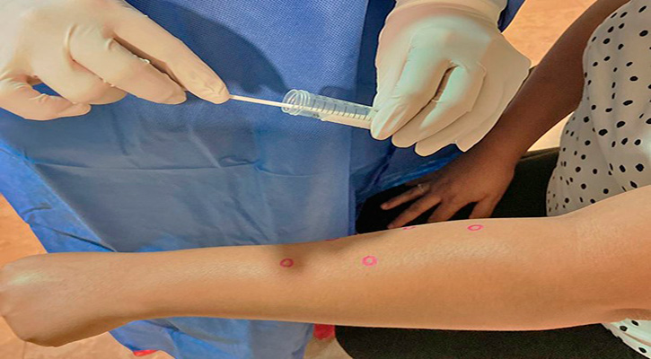 Mantiene la SSA vigilancia epidemiológica por viruela símica en BCS