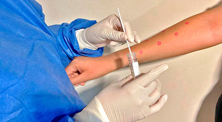 Se presenta nuevo caso de viruela símica en BCS