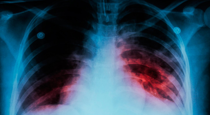 BCS por encima del promedio nacional de enfermos con tuberculosis