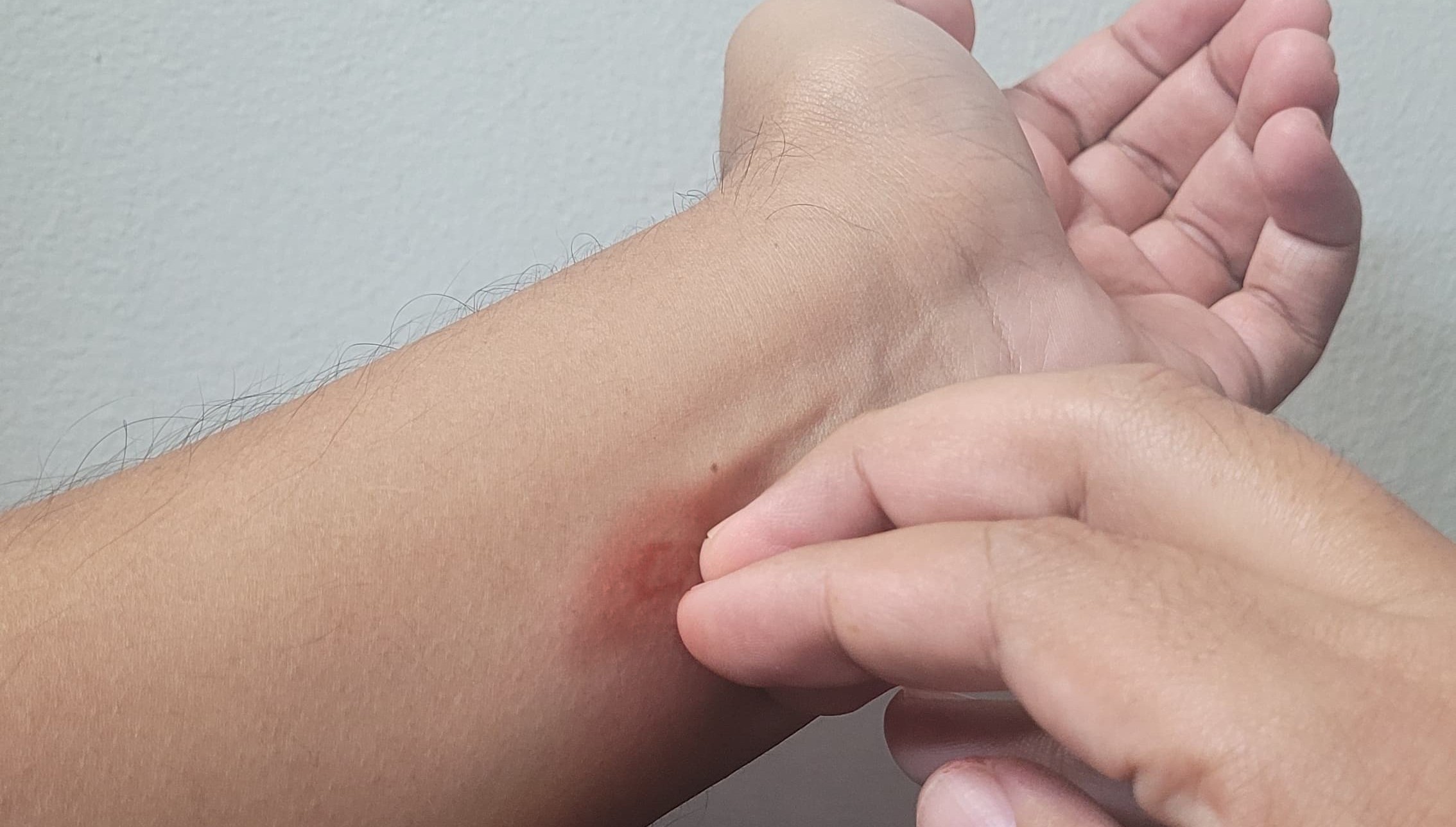 Llama IMSS a reconocer síntomas del dengue y evitar automedicación en BCS